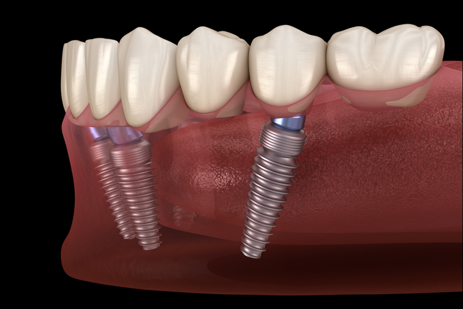Dentlab IsoImplants